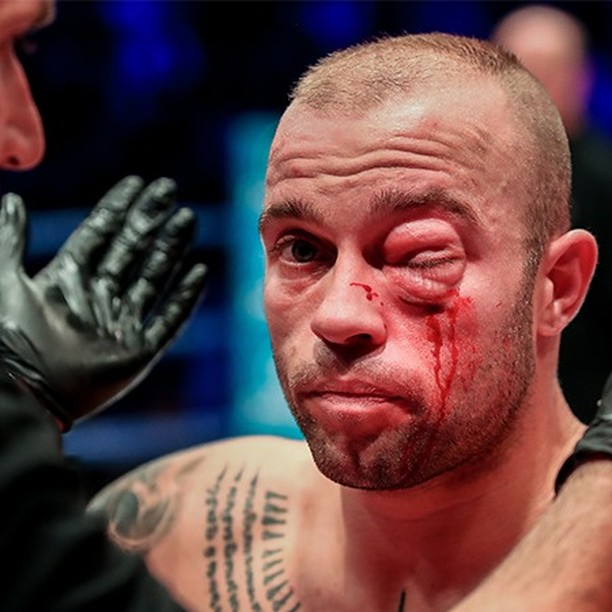  Alex Avogrado eye was bulging out of his socket