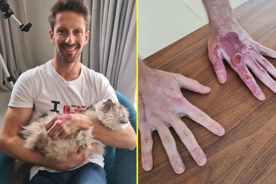 The Frenchman suffered gruesome burns