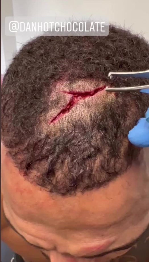Roberts needed stitches immediately after the victory