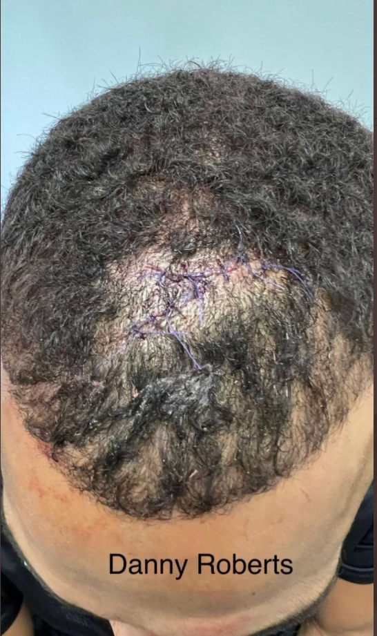The wound healed up quickly and the stitches should be out within two weeks
