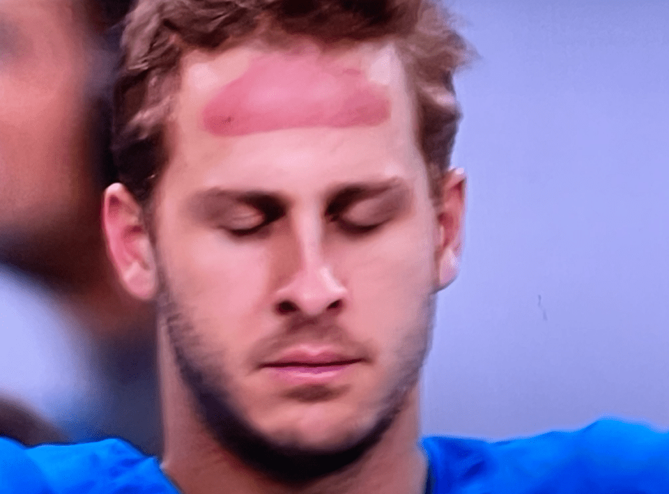 The bright red mark was clearly visible as Goff listened to the National Anthem