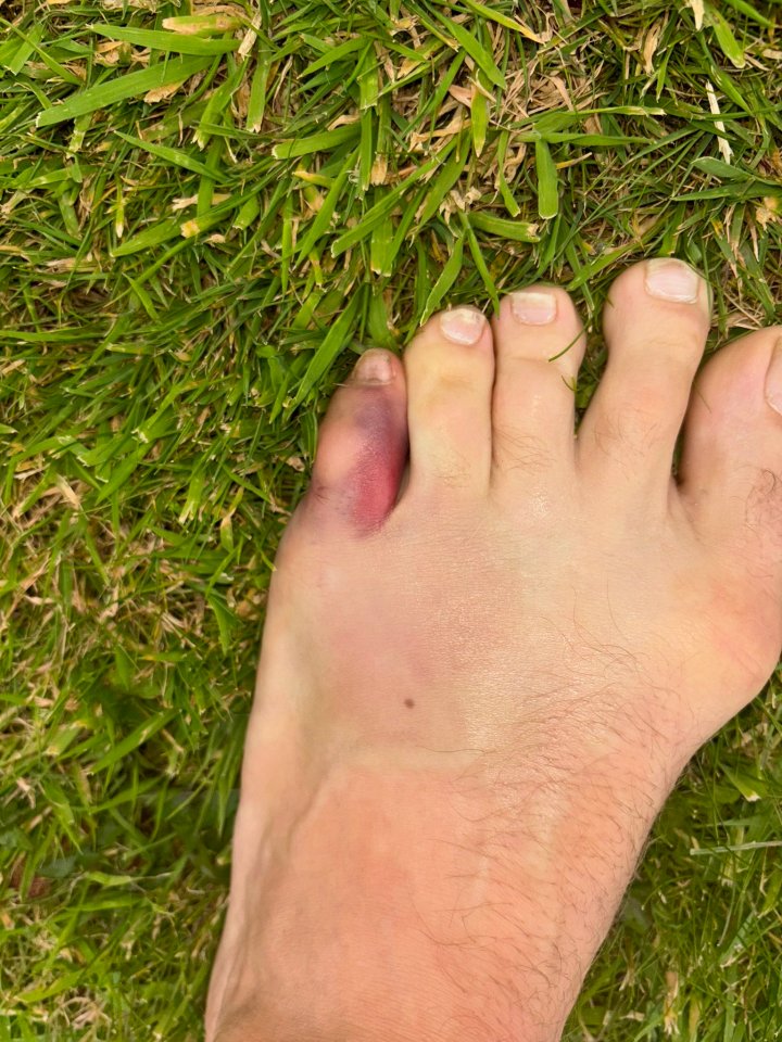 McGregor showed off his gruesome injury on social media