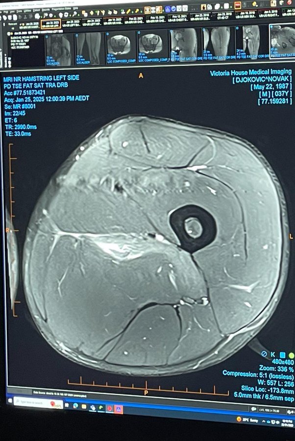 MRI scan of Novak Djokovic's left hamstring.
