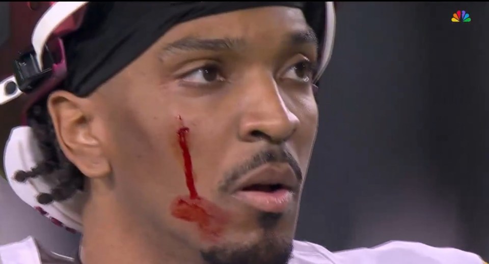 Daniels cut his face in the second quarter and needed medical attention