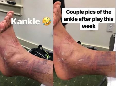Finau showed off the bruising and swelling after popping his ankle back in