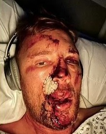 Flintoff was on the operating table for five hours