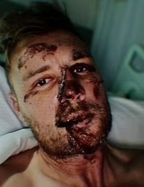 Flintoff wasn't wearing a helmet at the time of the accident